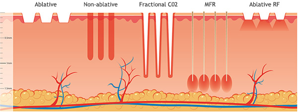 Microneedle Fractional RF